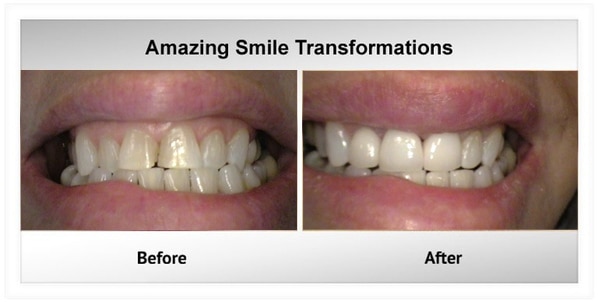 before and after dental treatment