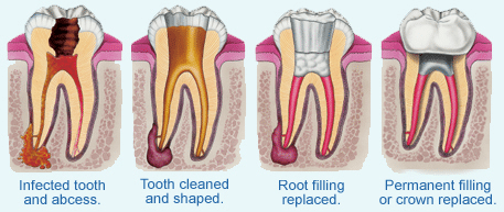 root canal process