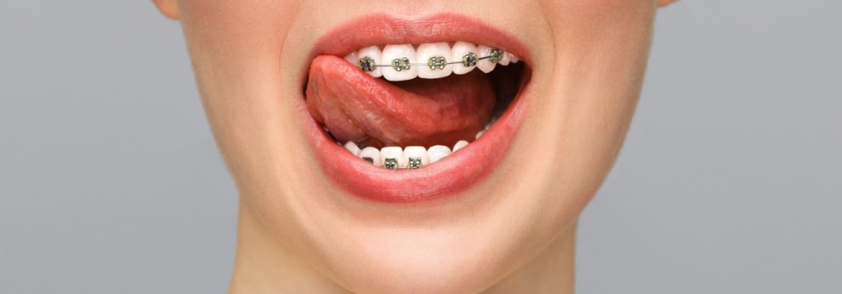 orthodontic-treatment-dental-care-concept-closeup-ceramic-metal-brackets-teeth-beautiful