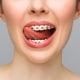 orthodontic-treatment-dental-care-concept-closeup-ceramic-metal-brackets-teeth-beautiful